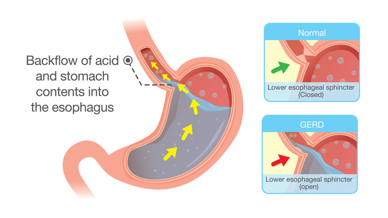 GERD and Acid Reflux: Understanding the Differences Between These Digestive Disorders